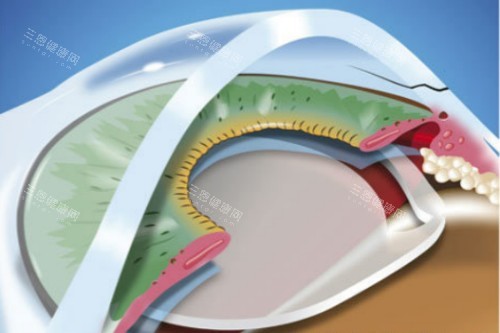 60歲以上活動！2026年愛爾眼科白內障手術免費政策實測，報銷比例+申請流程全分享！